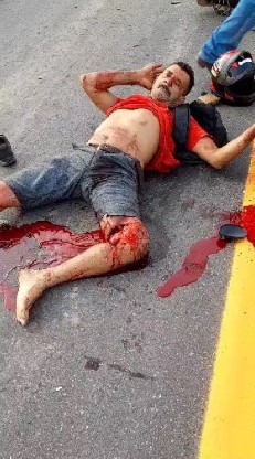 Man with his leg destroyed staying calm