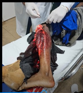 work worker was run over for R$1 a tractor wheel