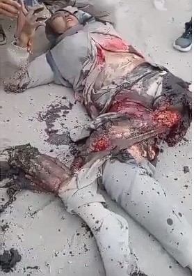 Half Of A Woman's Body Was Shattered By A Truck