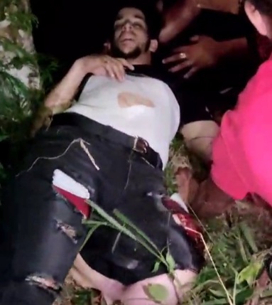 Horrific leg injury caused by motorcycle accident 