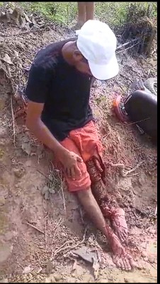 Dude Lost His Leg But Hold On Bravely