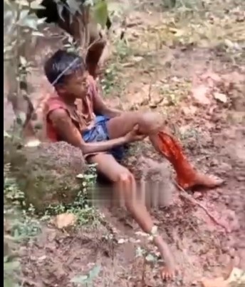 man has his leg torn apart in accident