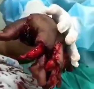 Man Has His Hand Completely Blown Off by Firework