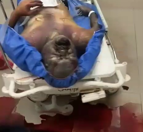 [HORRIFIC AND GROSS]A rotten body exploded in morgue 