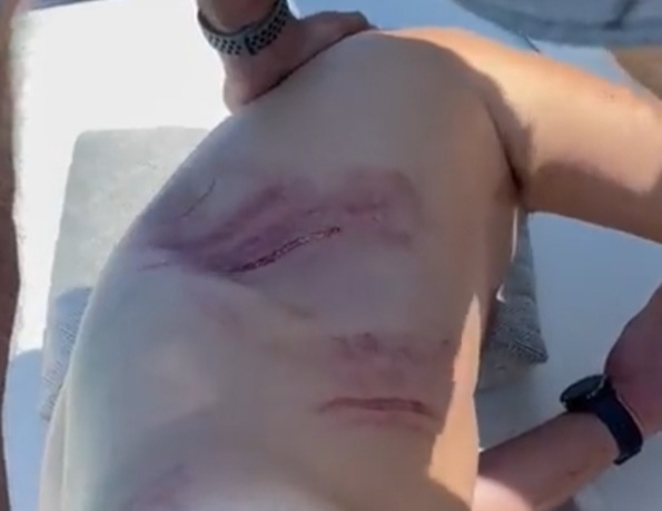 Motorcycle accident victim with several rib broken 