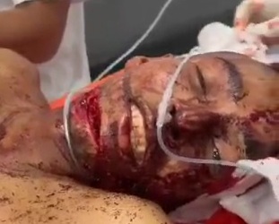 [PART 2]Victime of horrific machete attack hospitalized 