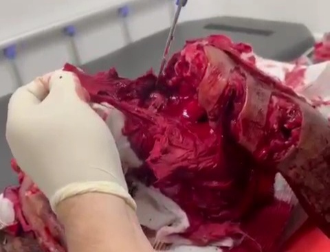 [PART 1]VICTIME OF HORRIFIC MACHETE ATTACK HOSPITALIZED