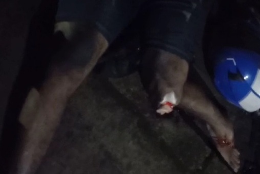 motorcycle crash leave man with Horrific leg injury 