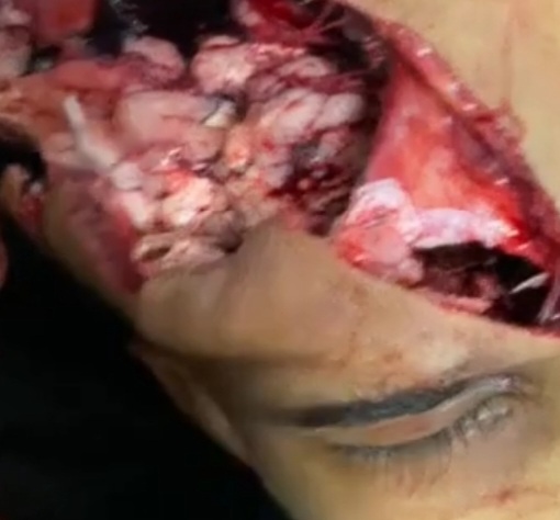 Criminal's Brains Exposed After Shootout With Police