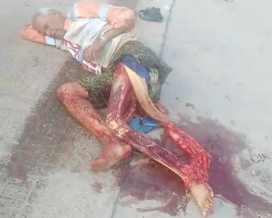 Horrific Skinned Leg from Bike Crash