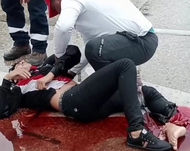 Horrible leg injury after motorcycle accident 