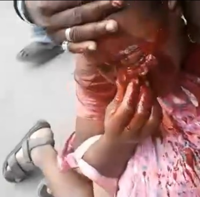 Woman a Bloody Mess after Being Shot in the Eye During a Robbery