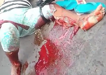 Woman with crashed legs after serious accident 