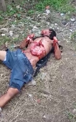 (2 angles) victim of grenade explosion