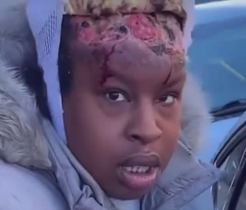 Woman with Necrosis on Head Injects Herself with Heroin