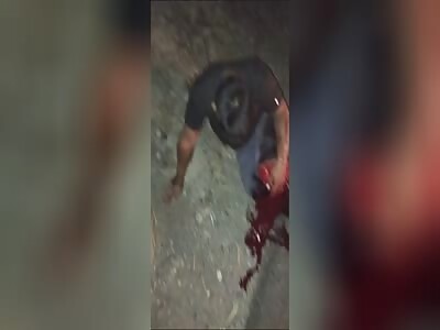 serious leg injuries 