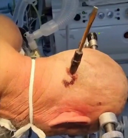 husband stuck a screwdriver in his wife's lover's head