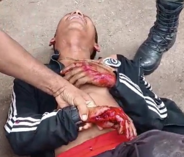 Hand wounded during machete fight 