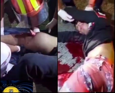 Open femoral fracture in a 30 year old man from a road accident