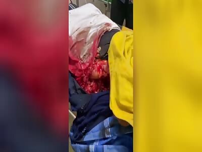 Indonesian woman dying after hit by a truck