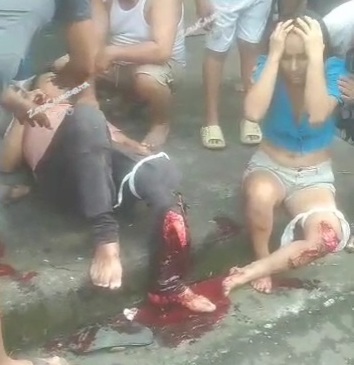 Couple suffered from two horrific leg injurie due to motorcycle crash