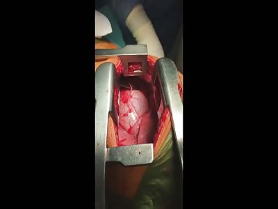 Spanish Surgeaons Remove Sword Next to Still-Beating Heart of Man 