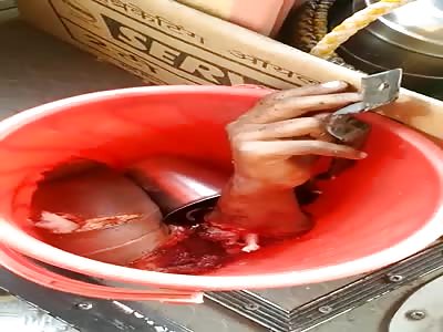 School Boy Lost His Arm While Traveling in School Bus (Aftermath)