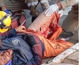 motorcyclist had grazed leg