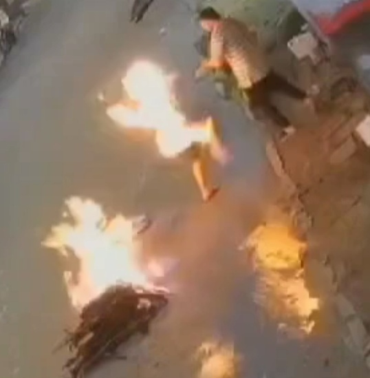 The 32-Year-old Idiot Was Sent To The Hospital With Severe Burns