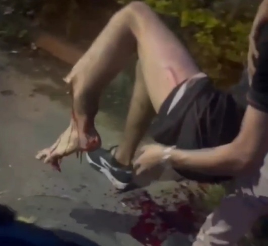 Horrific women leg crashed by drunk driver