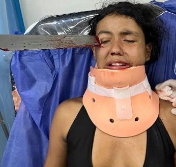 Argument Leads to Girl with Machete Stuck in her Face