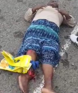 Two women's with broken legs after a traffic accident 