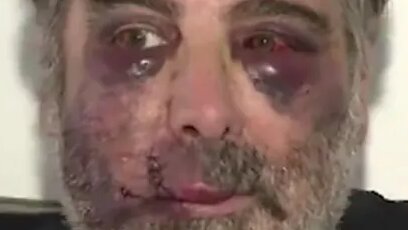 Man Brutally Beaten at His Home in Spain (Aftermath)