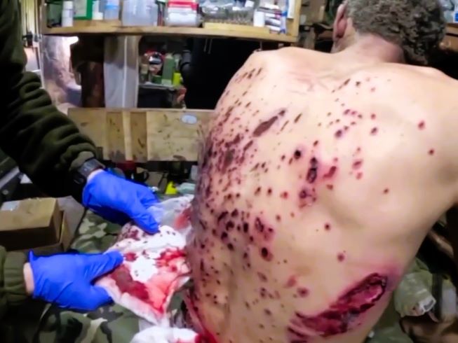 Behind the Scenes: 'Swiss-Cheesed' Russian Soldier in ER