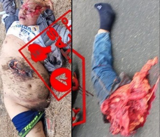 Horrific deadly motorcycle accident leave man with leg amputed 