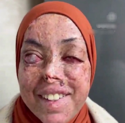 Young blind woman with melted face 