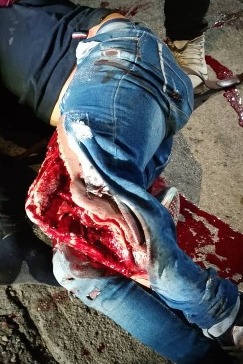 victim has leg torn in accident