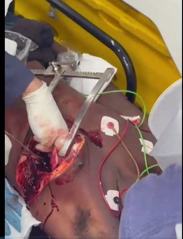 rapid opening of gunshot victim