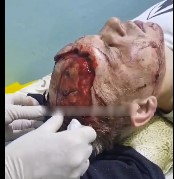 DAMN: Bear Ripped off Homies Scalp.