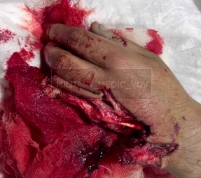 Russian soldier shattred hand 