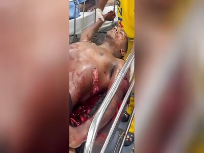 rio de janeiro: guts coming out of 5.56mm rifle shot