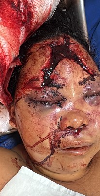 Woman Beaten with Iron Bar by Husband.