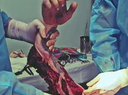 [PART 1]Russian doctors preparing for the imputation of soldier shattred arm 