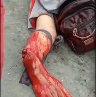 Thief's Both Arms Severed By Machete (Aftermath)