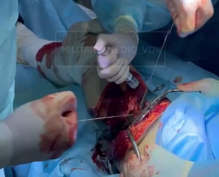 [HORRIFIC FOOTAGE]RUSSIAN WOUNDED SOLDIER GETS HIS LEG AMPUTED 