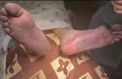 [LIKE A HORROR MOVIES]Russian doctors amputed soldier frostbite leg 