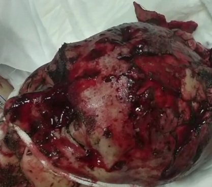 [BRAIN OUT]Russian wounded soldier with his brain out hospitalized 