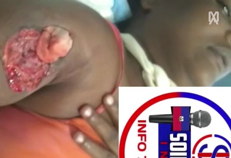 Haitian woman hospitalized after getting shot by a stray bullet 