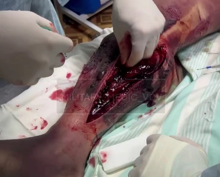 Russian wounded soldier hospitalized after stepping on a landmine 