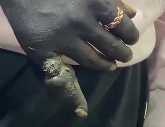 Pinky about to fall clean off!!! 